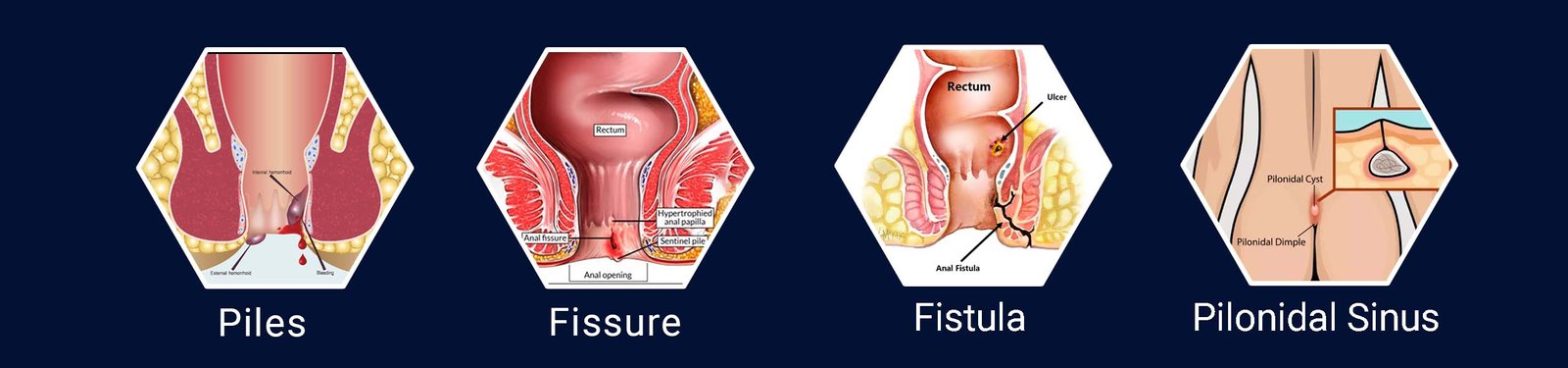 Fissure Treatment (फिशर गुदचीर)